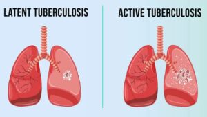 35 Persons Die Of Tuberculosis In Nasarawa State